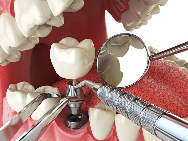 Best Broken or Cracked Tooth Emergency Dentist in Ravena, NY